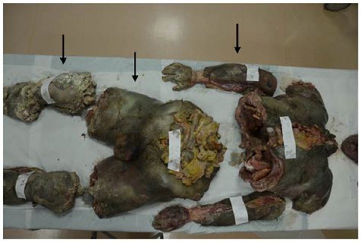 The Bizarre Case Of Tarrare: An Autopsy Of His Organs And Life