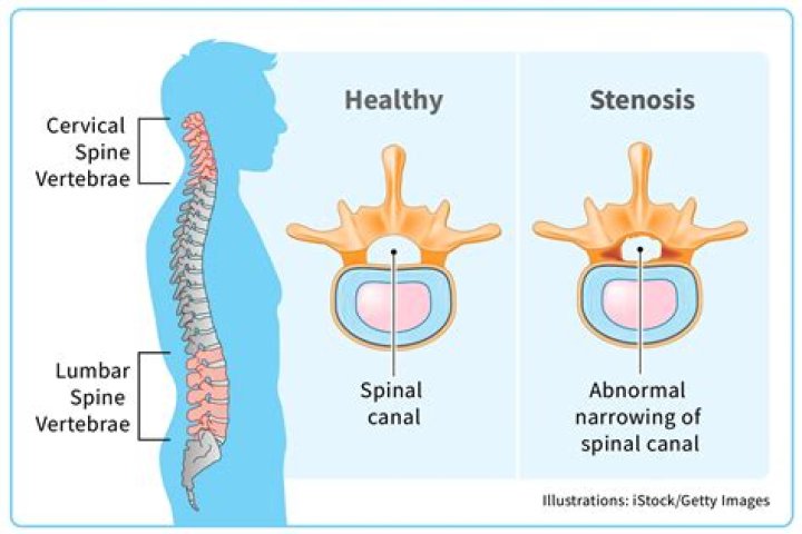 Understanding Spinal Stenosis Through The Lens Of Cooper Manning